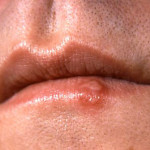 cdc_cold_sore_closeup_lips